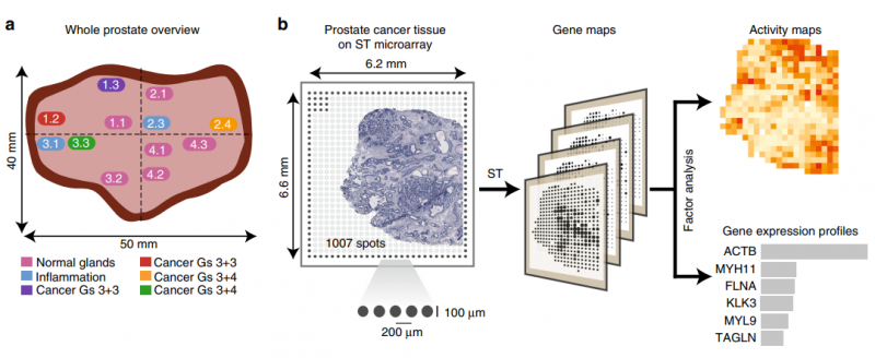 前列腺癌的空間轉(zhuǎn)錄組學(xué)（ST) 研究設(shè)計(jì)