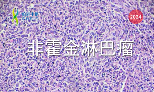 文獻解讀 | PD- 1 在 T 細胞淋巴瘤中相關抑制代謝程序，限制糖酵解和抑制 AP- 1 活性