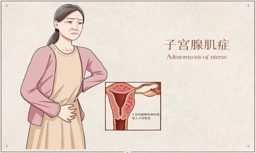 文獻解讀 | 單細胞 RNA 測序與空間轉錄組學相結合破譯的子宮腺肌病綜合轉錄圖譜